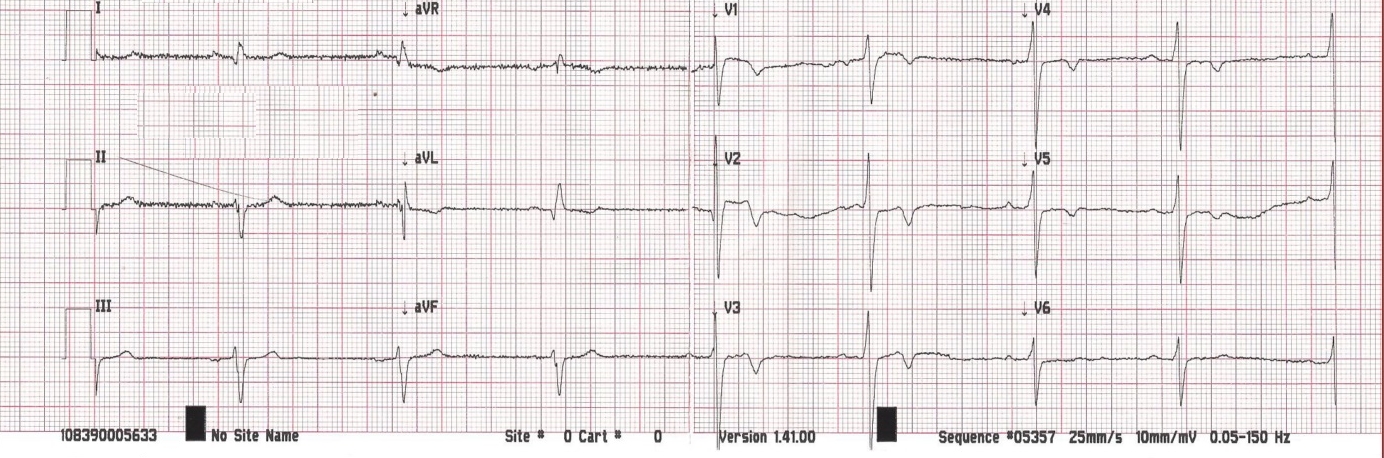 ECG apriliou.png